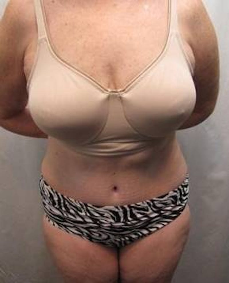 Tummy Tuck Before & After Gallery - Patient 802597 - Image 2 - Scott Chapin, MD
