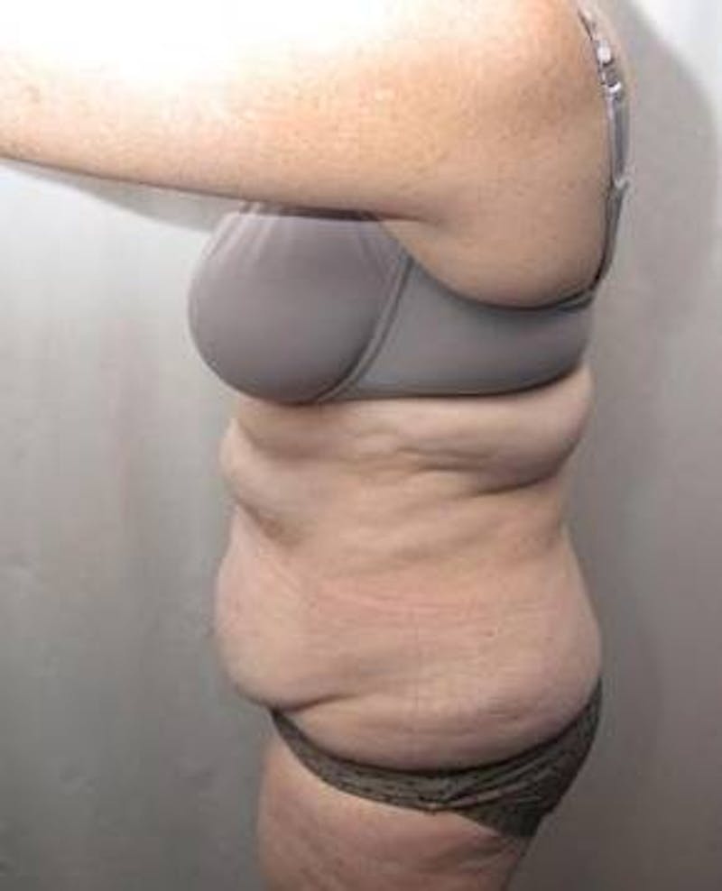 Tummy Tuck Before & After Gallery - Patient 802597 - Image 3 - Scott Chapin, MD