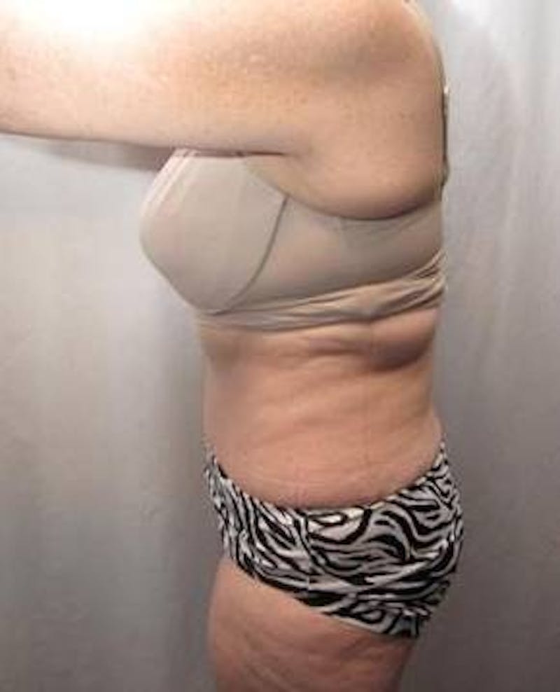 Tummy Tuck Before & After Gallery - Patient 802597 - Image 4 - Scott Chapin, MD