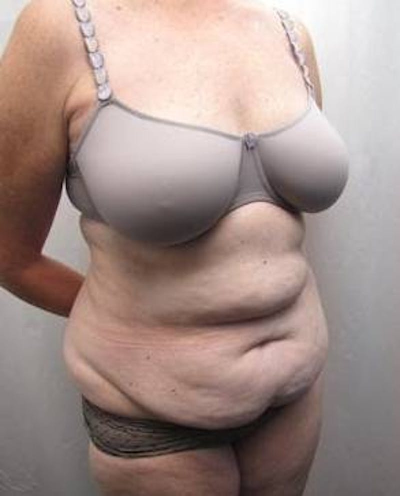 Tummy Tuck Before & After Gallery - Patient 802597 - Image 5 - Scott Chapin, MD
