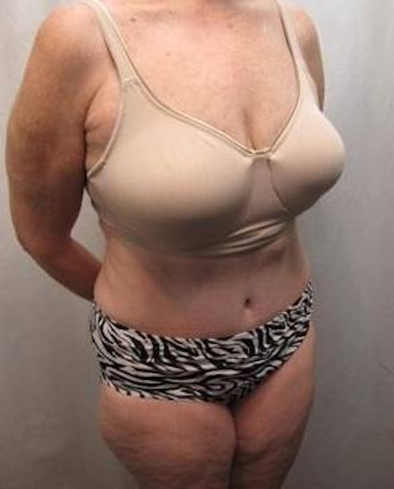 Tummy Tuck Before & After Gallery - Patient 802597 - Image 6 - Scott Chapin, MD