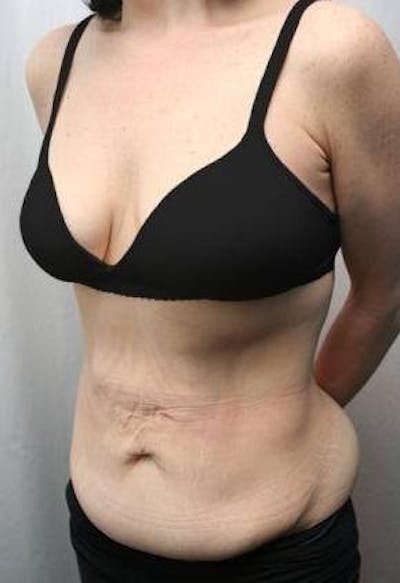 Tummy Tuck Before & After Gallery - Patient 157814 - Image 1 - Scott Chapin, MD