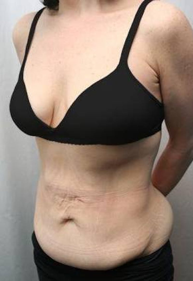 Tummy Tuck Before & After Gallery - Patient 157814 - Image 1 - Scott Chapin, MD