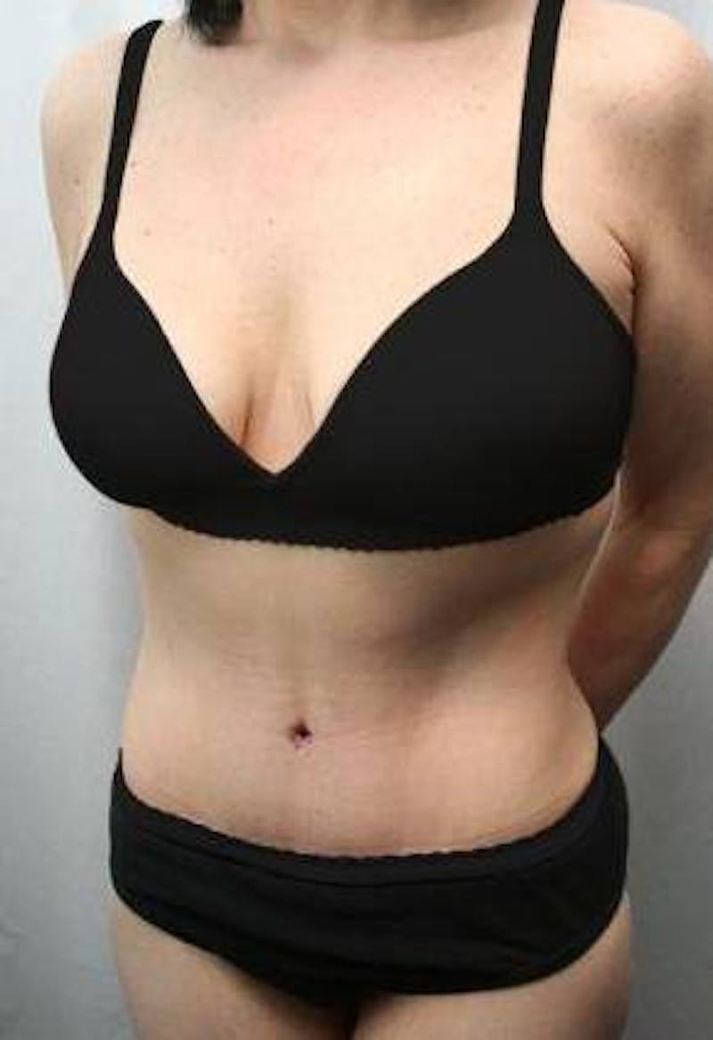 Tummy Tuck Before & After Gallery - Patient 157814 - Image 2 - Scott Chapin, MD