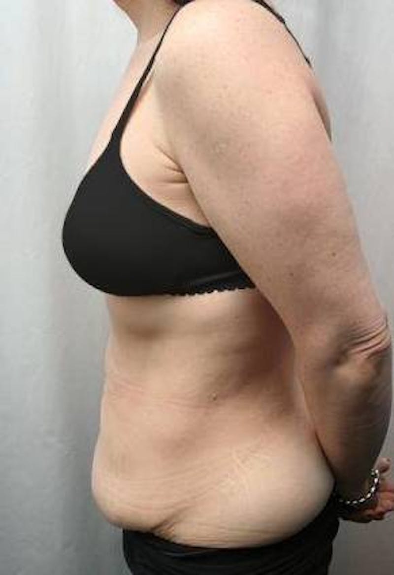 Tummy Tuck Before & After Gallery - Patient 157814 - Image 3 - Scott Chapin, MD