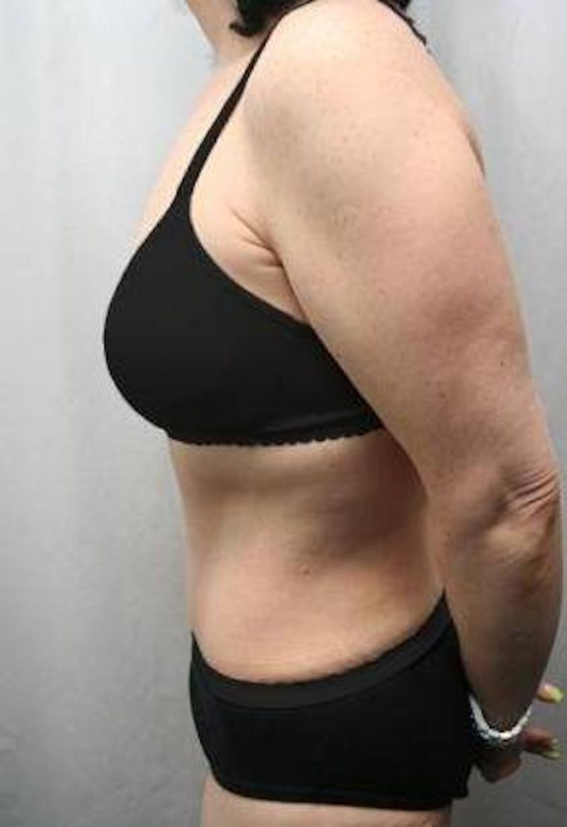 Tummy Tuck Before & After Gallery - Patient 157814 - Image 4 - Scott Chapin, MD