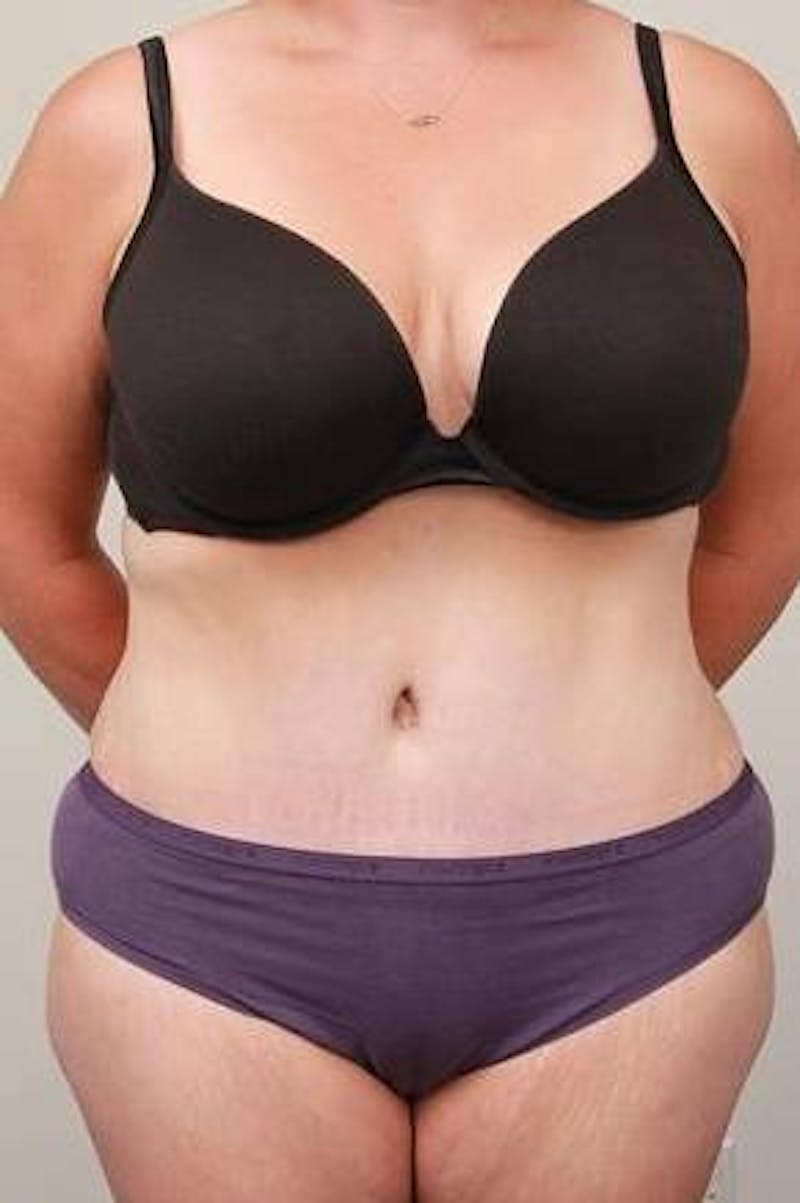 Tummy Tuck Before & After Gallery - Patient 369536 - Image 2 - Scott Chapin, MD