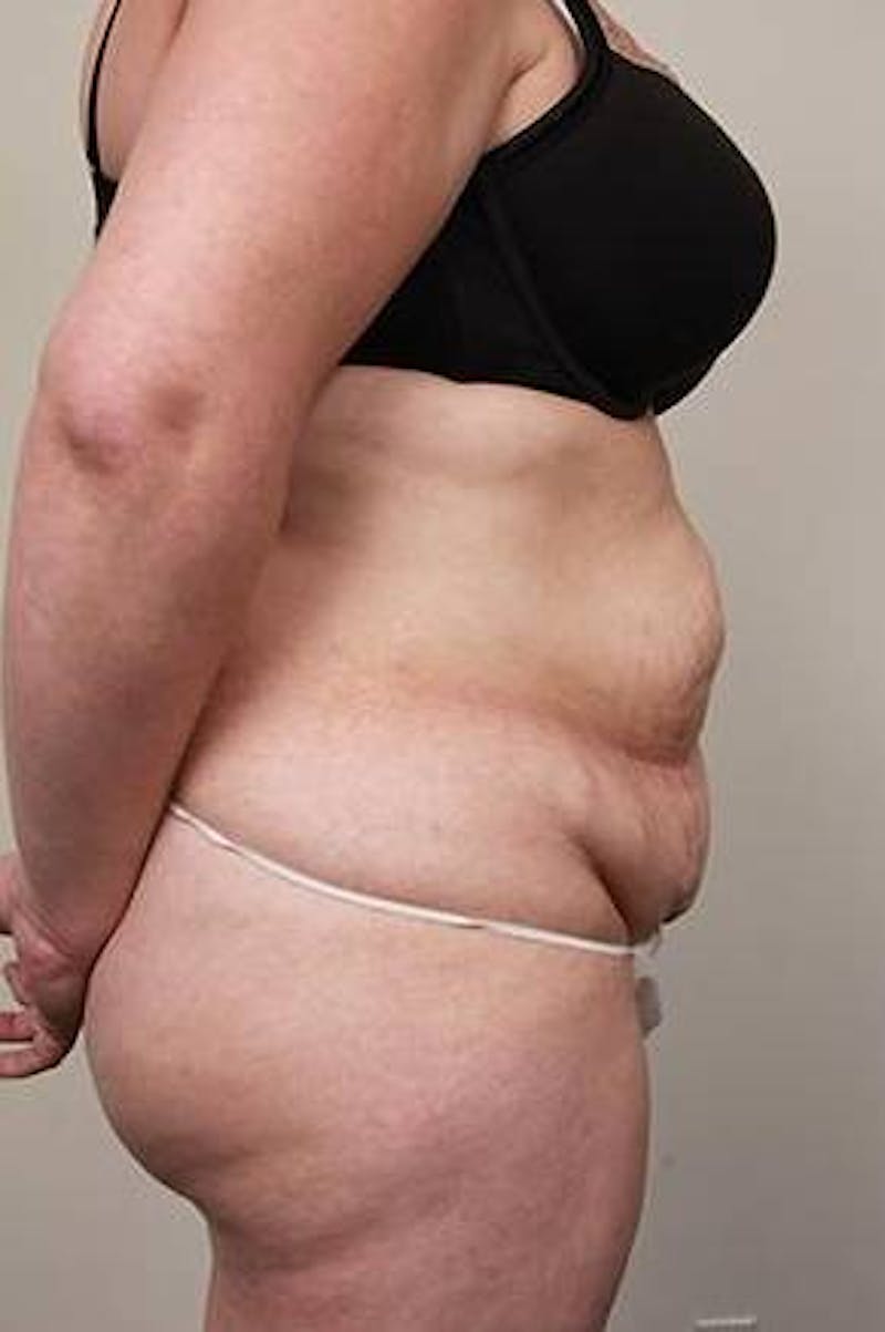 Tummy Tuck Before & After Gallery - Patient 369536 - Image 3 - Scott Chapin, MD