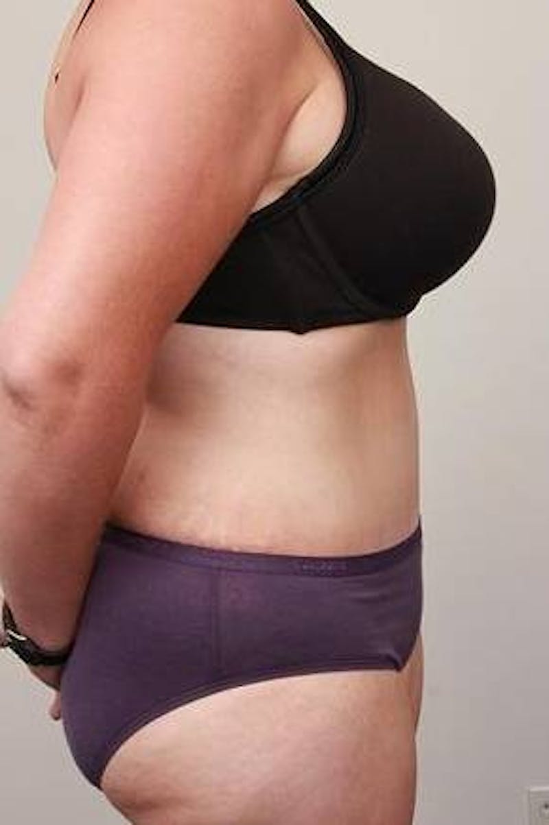 Tummy Tuck Before & After Gallery - Patient 369536 - Image 4 - Scott Chapin, MD