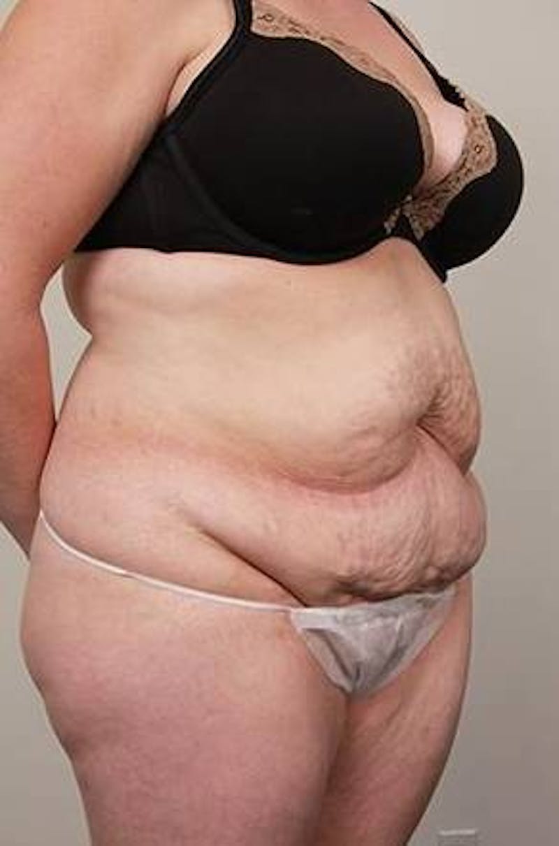 Tummy Tuck Before & After Gallery - Patient 369536 - Image 5 - Scott Chapin, MD