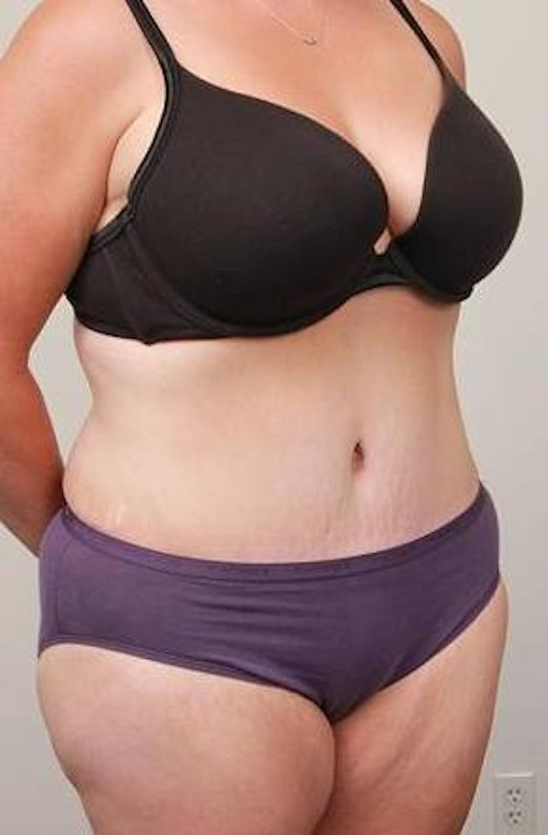 Tummy Tuck Before & After Gallery - Patient 369536 - Image 6 - Scott Chapin, MD