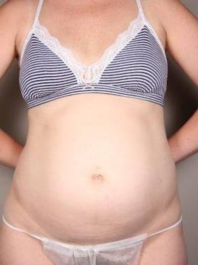 Tummy Tuck Before & After Gallery - Patient 329544 - Image 1 - Scott Chapin, MD