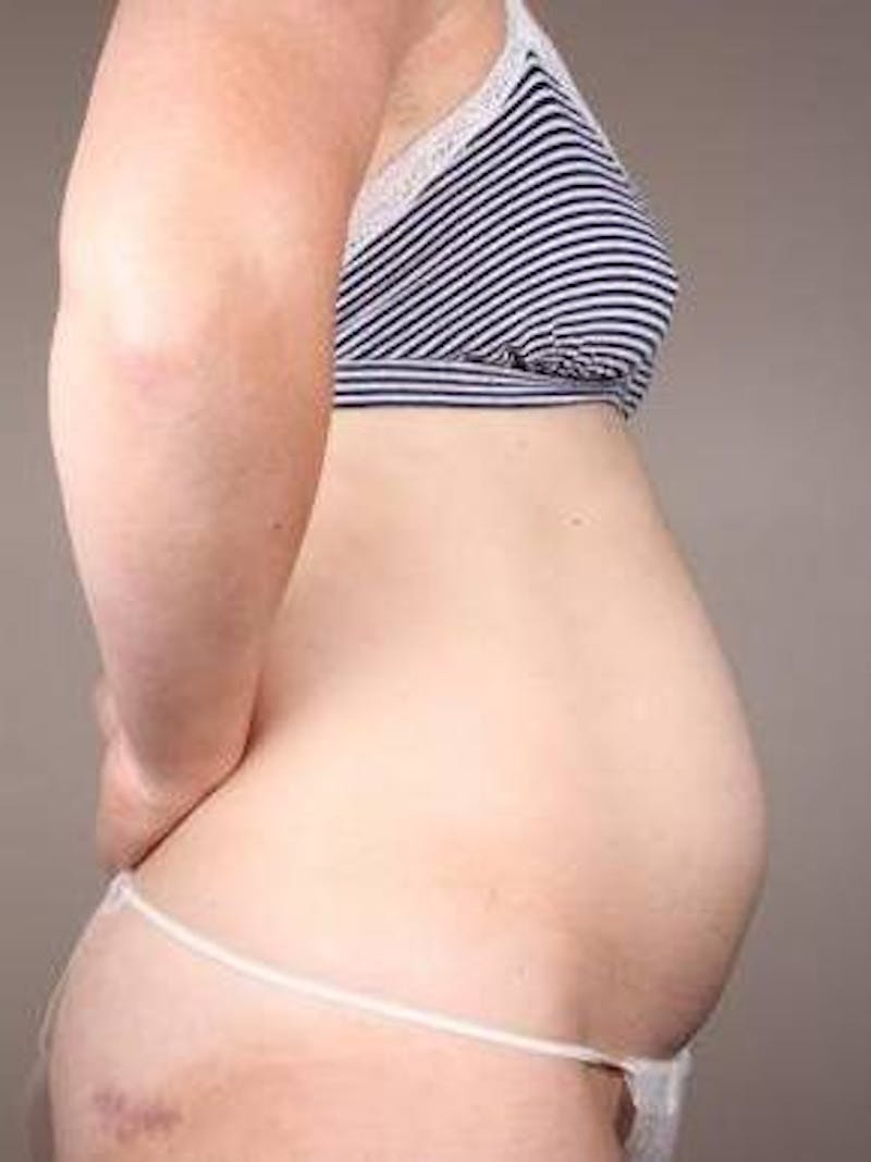 Tummy Tuck Before & After Gallery - Patient 329544 - Image 3 - Scott Chapin, MD