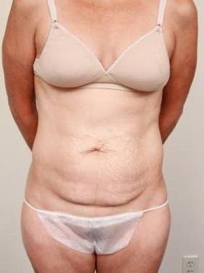 Tummy Tuck Before & After Gallery - Patient 807460 - Image 1 - Scott Chapin, MD