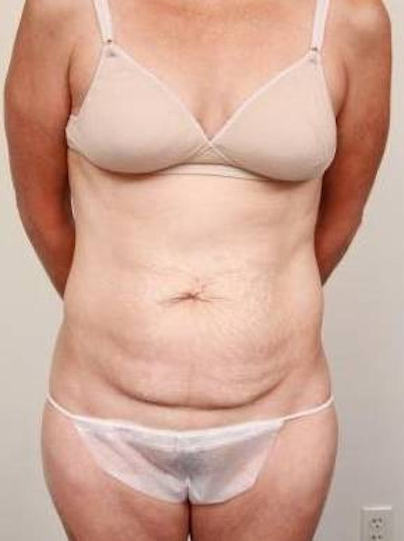 Tummy Tuck Before & After Gallery - Patient 807460 - Image 1 - Scott Chapin, MD