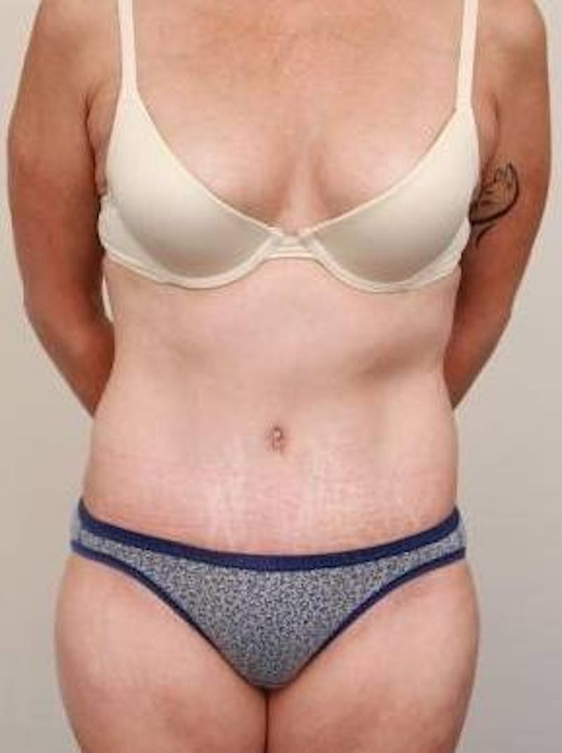 Tummy Tuck Before & After Gallery - Patient 807460 - Image 2 - Scott Chapin, MD