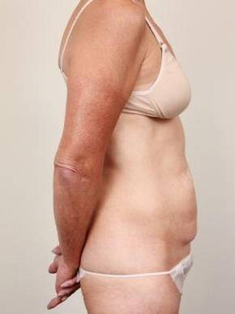 Tummy Tuck Before & After Gallery - Patient 807460 - Image 3 - Scott Chapin, MD