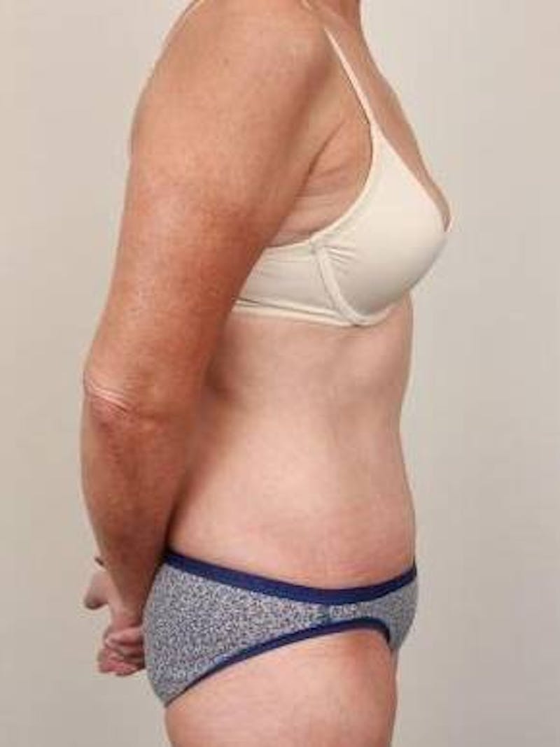 Tummy Tuck Before & After Gallery - Patient 807460 - Image 4 - Scott Chapin, MD