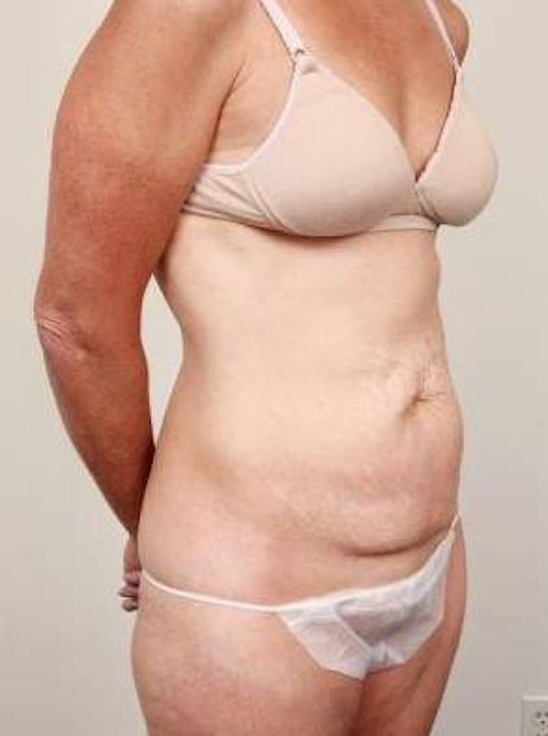 Tummy Tuck Before & After Gallery - Patient 807460 - Image 5 - Scott Chapin, MD