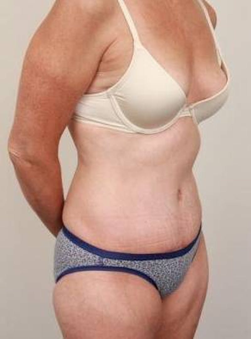 Tummy Tuck Before & After Gallery - Patient 807460 - Image 6 - Scott Chapin, MD