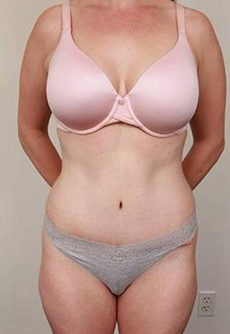 Tummy Tuck Before & After Gallery - Patient 100405 - Image 2 - Scott Chapin, MD