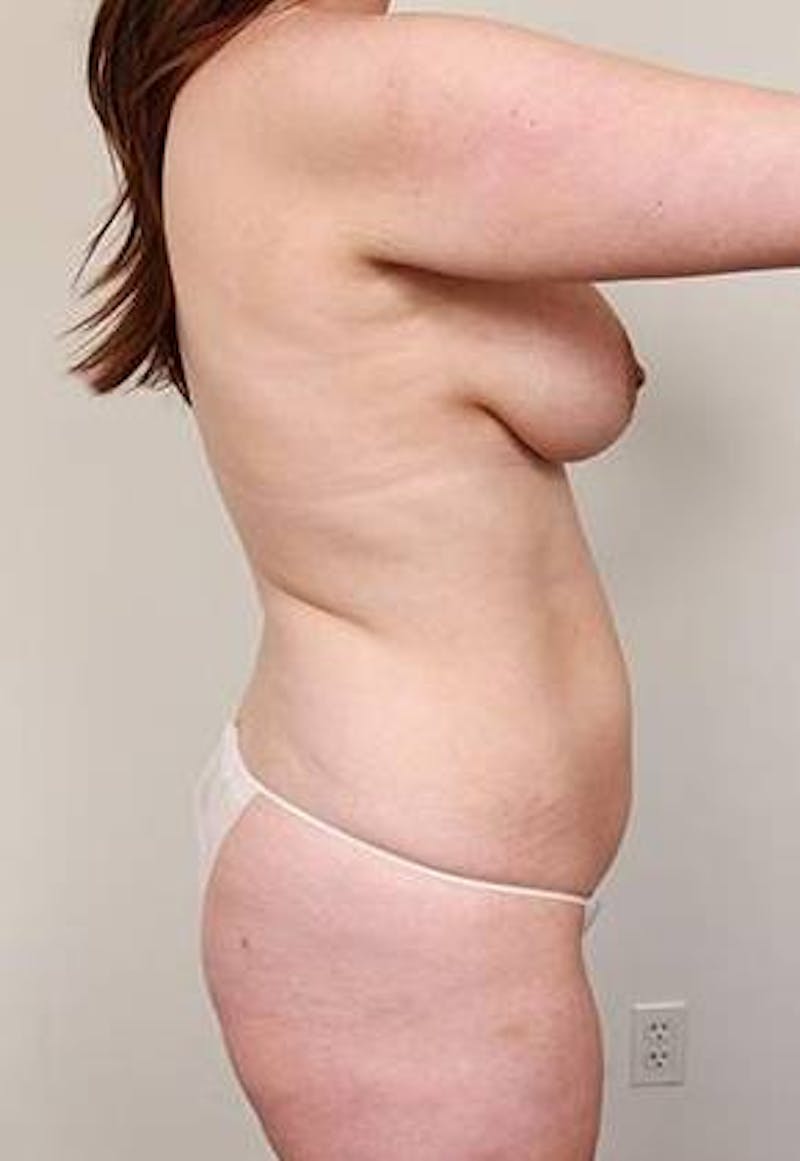 Tummy Tuck Before & After Gallery - Patient 100405 - Image 3 - Scott Chapin, MD