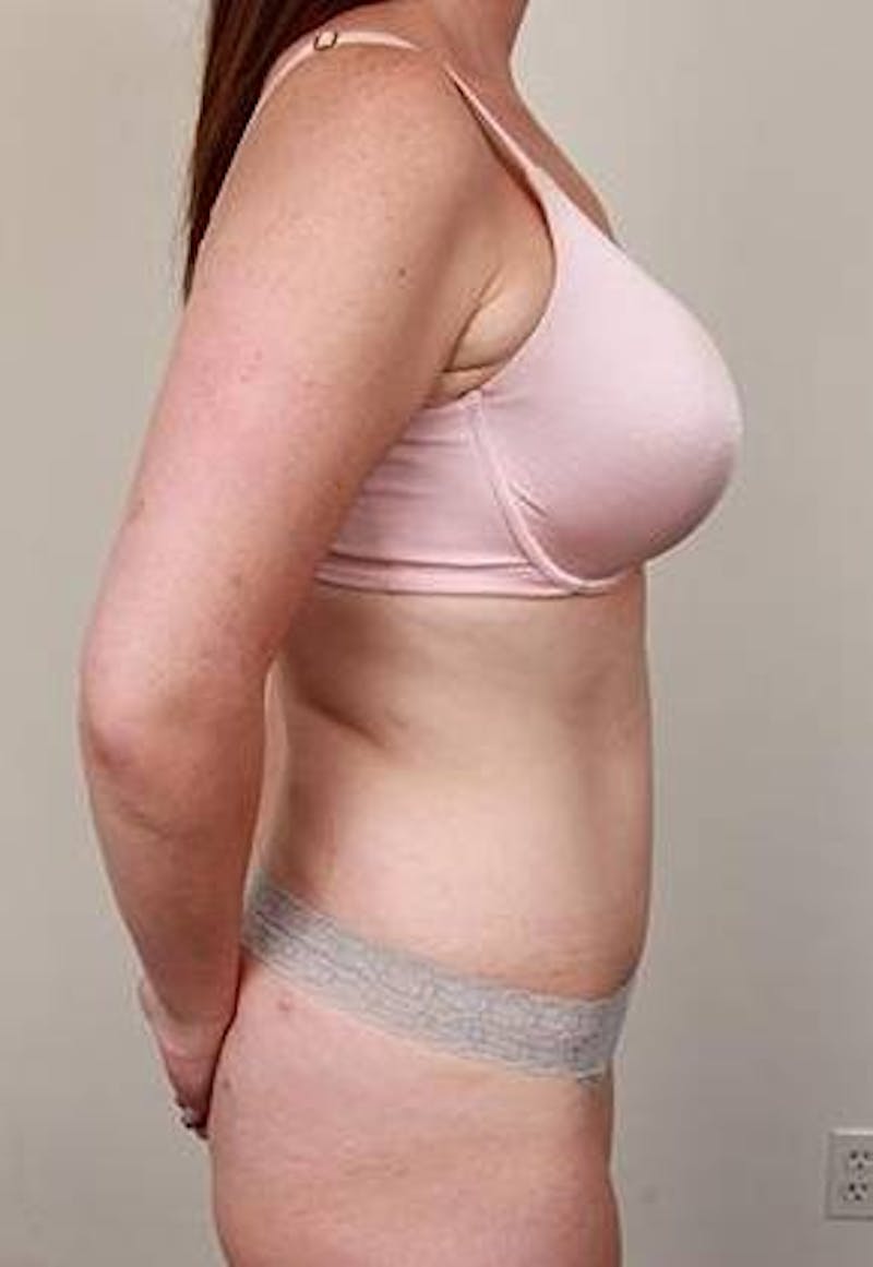 Tummy Tuck Before & After Gallery - Patient 100405 - Image 4 - Scott Chapin, MD