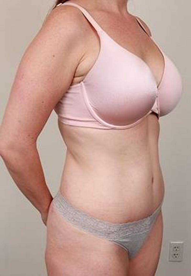 Tummy Tuck Before & After Gallery - Patient 100405 - Image 6 - Scott Chapin, MD