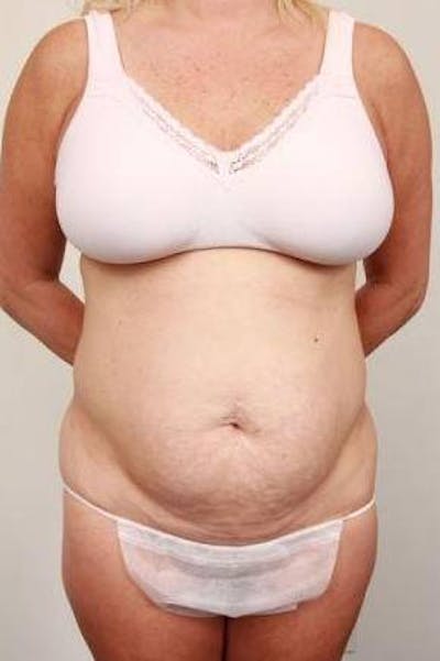 Tummy Tuck Before & After Gallery - Patient 301647 - Image 1 - Scott Chapin, MD