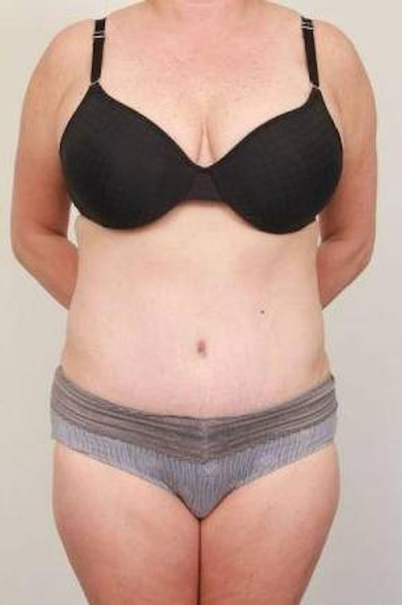 Tummy Tuck Before & After Gallery - Patient 301647 - Image 2 - Scott Chapin, MD