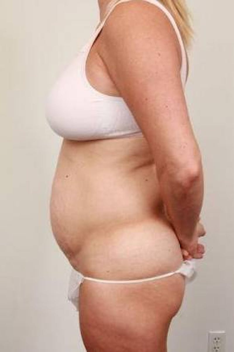 Tummy Tuck Before & After Gallery - Patient 301647 - Image 3 - Scott Chapin, MD