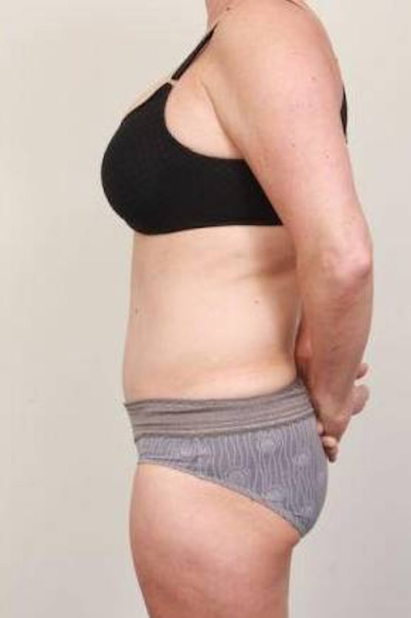 Tummy Tuck Before & After Gallery - Patient 301647 - Image 4 - Scott Chapin, MD