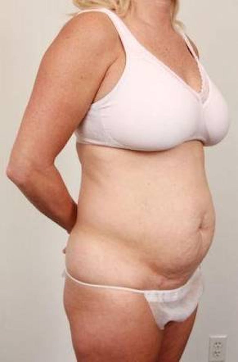 Tummy Tuck Before & After Gallery - Patient 301647 - Image 5 - Scott Chapin, MD