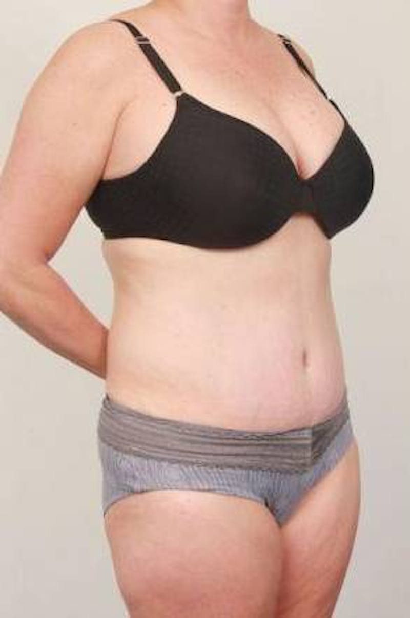 Tummy Tuck Before & After Gallery - Patient 301647 - Image 6 - Scott Chapin, MD