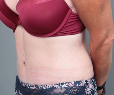 Tummy Tuck Before & After Gallery - Patient 180049 - Image 2 - Scott Chapin, MD