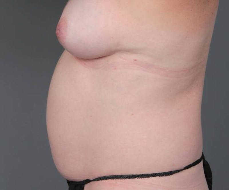 Tummy Tuck Before & After Gallery - Patient 180049 - Image 3 - Scott Chapin, MD
