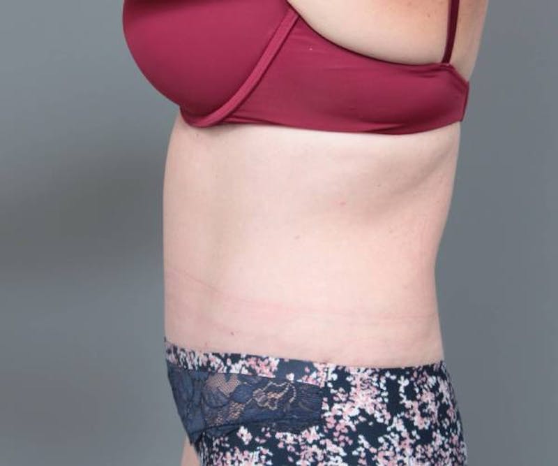 Tummy Tuck Before & After Gallery - Patient 180049 - Image 4 - Scott Chapin, MD
