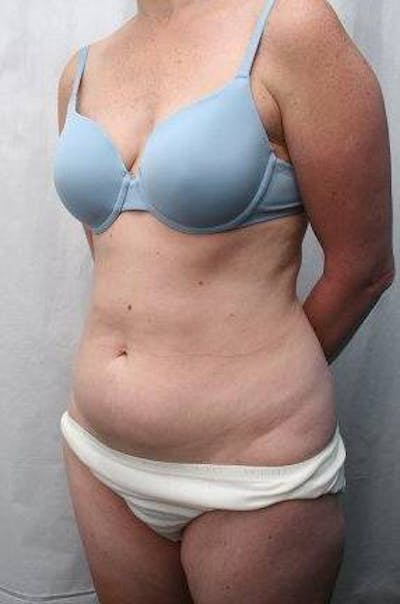 Mini Tummy Tuck Before & After Gallery - Patient 147554 - Image 1 - Scott Chapin, MD