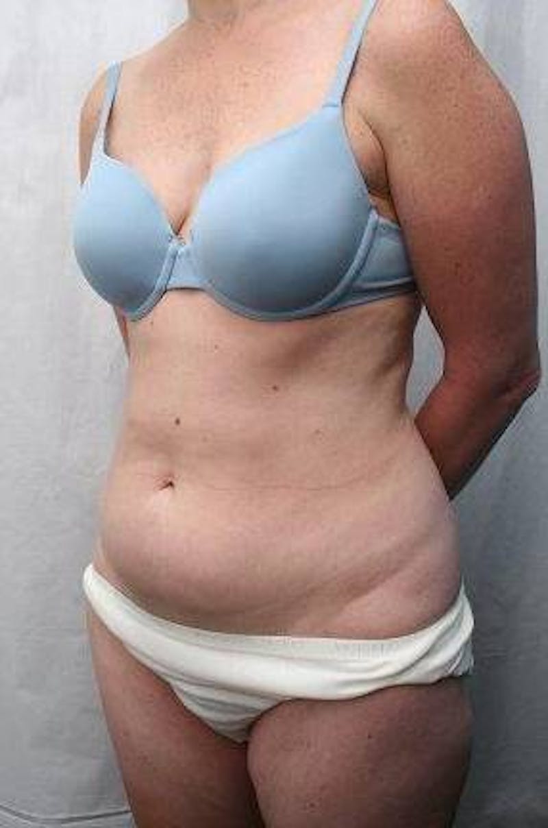 Mini Tummy Tuck Before & After Gallery - Patient 147554 - Image 1 - Scott Chapin, MD