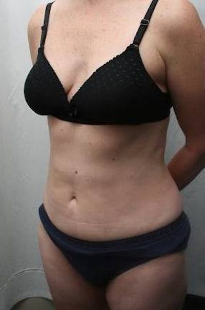 Mini Tummy Tuck Before & After Gallery - Patient 147554 - Image 2 - Scott Chapin, MD