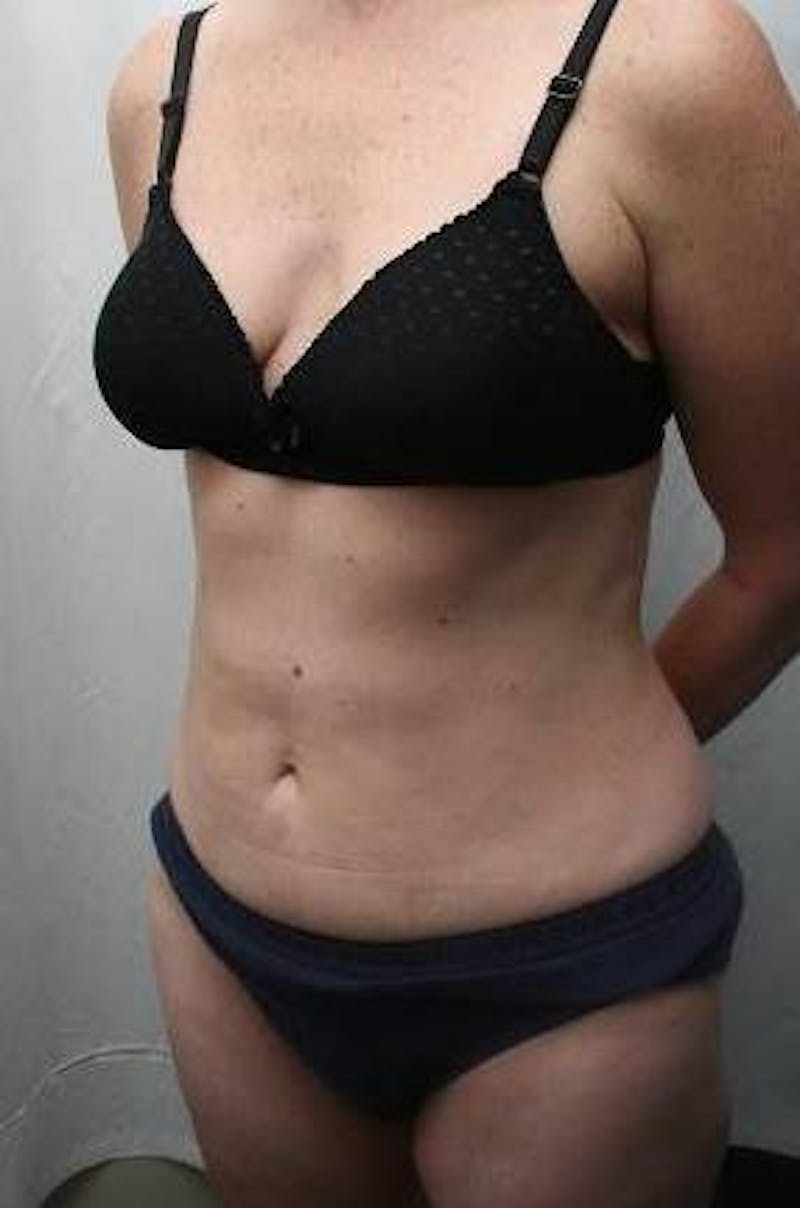 Mini Tummy Tuck Before & After Gallery - Patient 147554 - Image 2 - Scott Chapin, MD