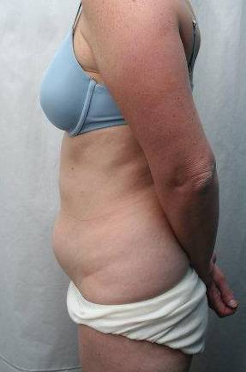 Mini Tummy Tuck Before & After Gallery - Patient 147554 - Image 3 - Scott Chapin, MD