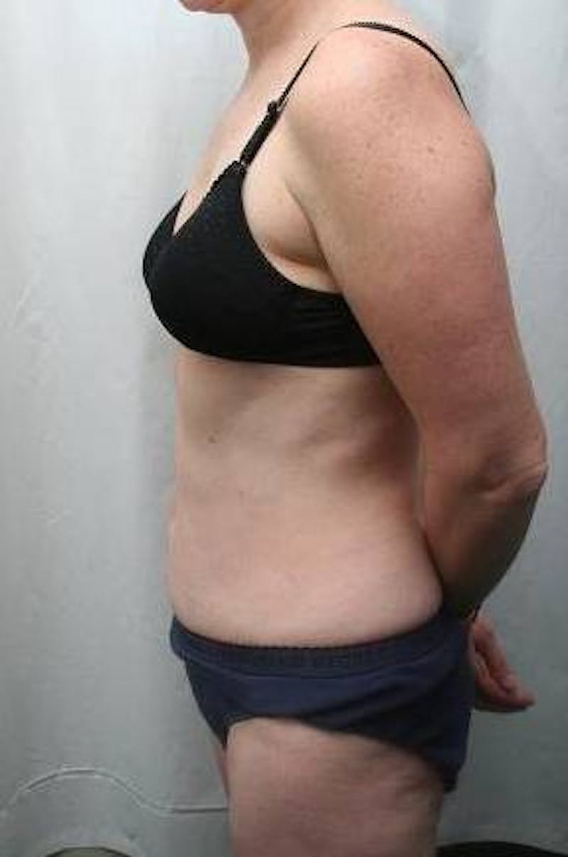 Mini Tummy Tuck Before & After Gallery - Patient 147554 - Image 4 - Scott Chapin, MD