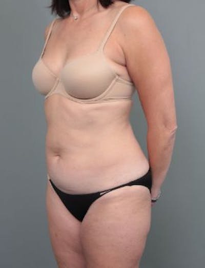 Liposuction Before & After Gallery - Patient 354021 - Image 1 - Scott Chapin, MD