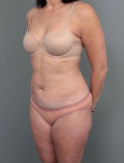 Liposuction Before & After Gallery - Patient 354021 - Image 2 - Scott Chapin, MD
