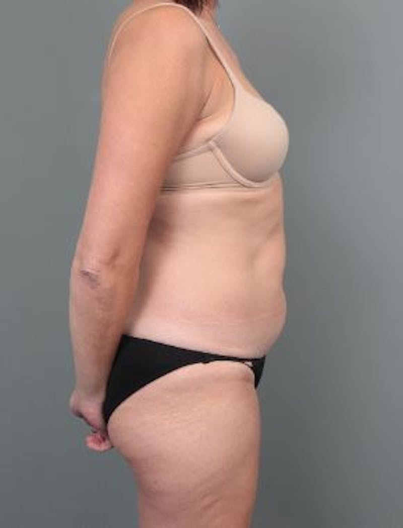 Liposuction Before & After Gallery - Patient 354021 - Image 3 - Scott Chapin, MD