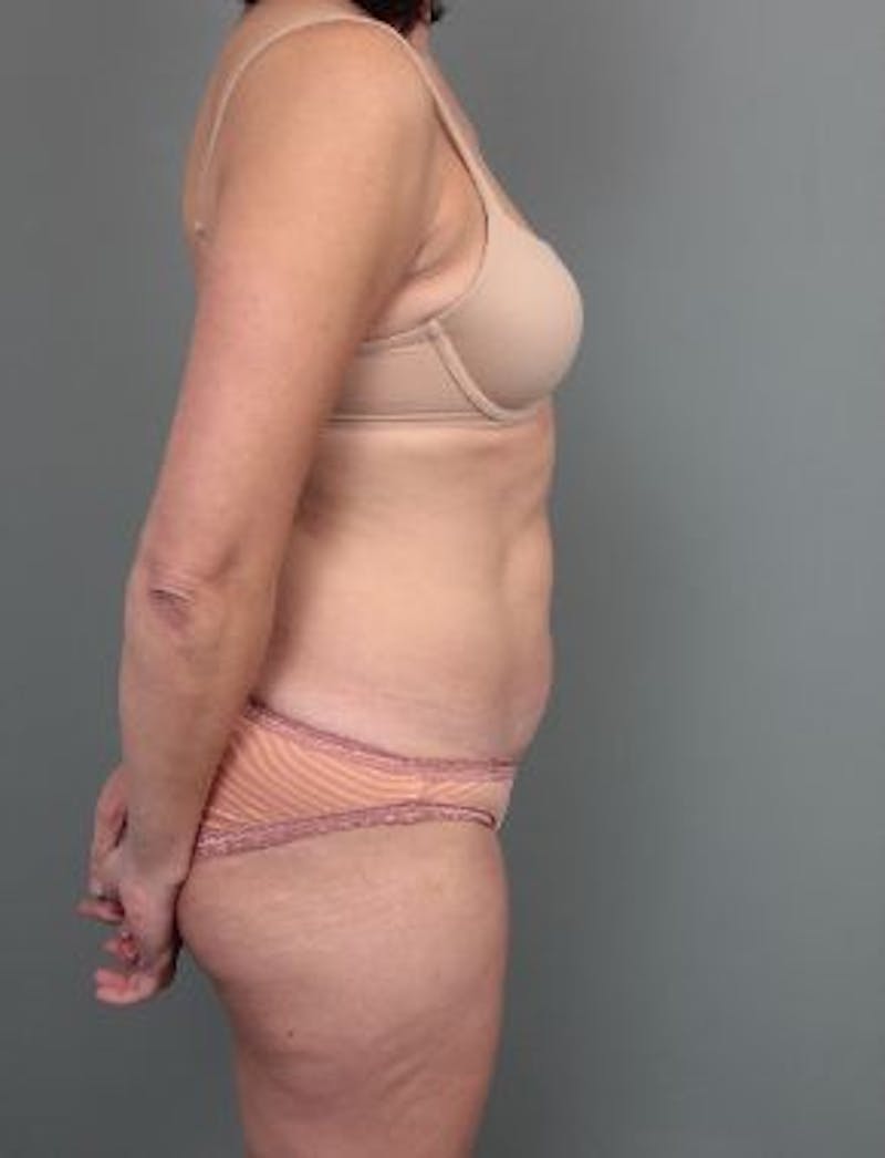 Liposuction Before & After Gallery - Patient 354021 - Image 4 - Scott Chapin, MD