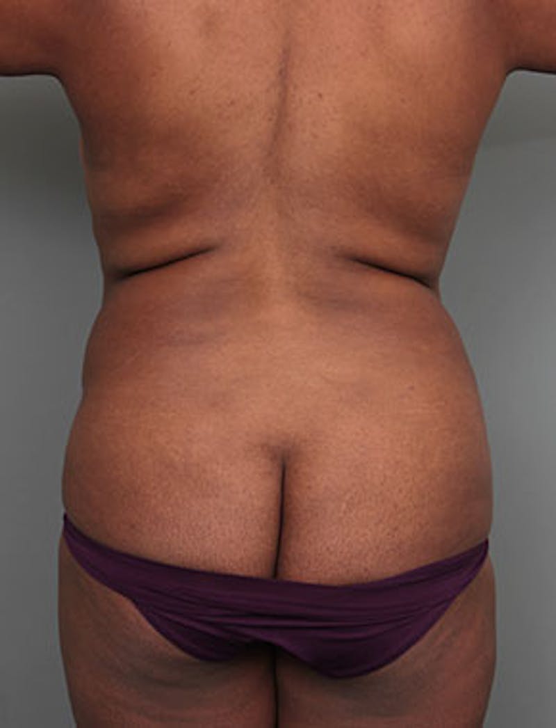 Liposuction Before & After Gallery - Patient 349960 - Image 1 - Scott Chapin, MD