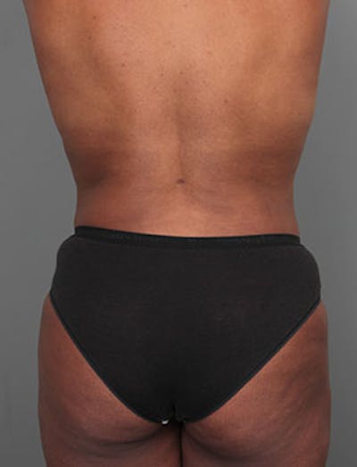 Liposuction Before & After Gallery - Patient 349960 - Image 2 - Scott Chapin, MD