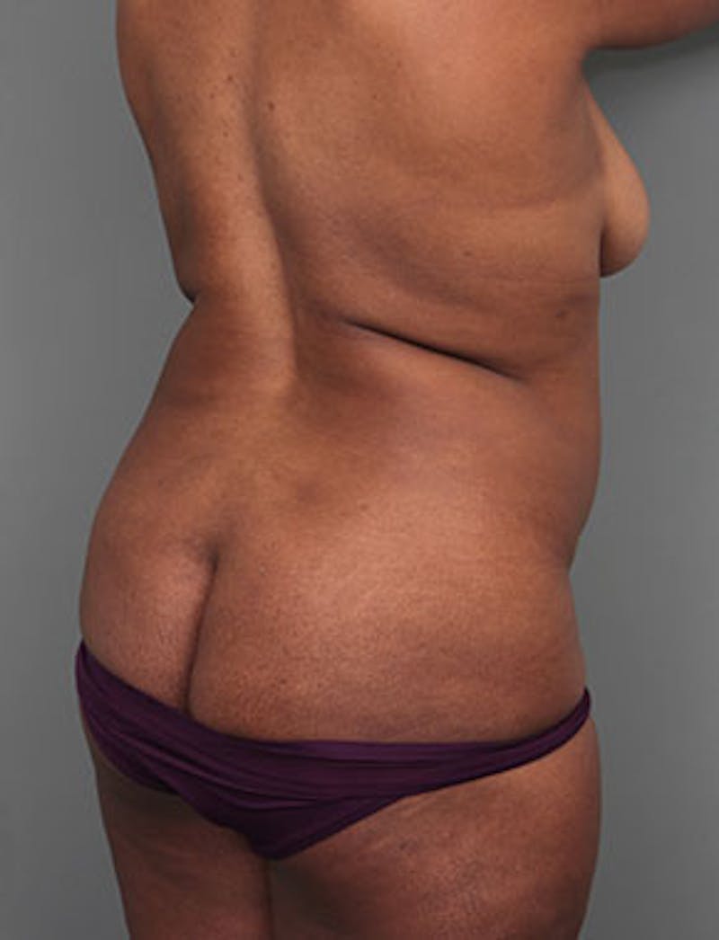 Liposuction Before & After Gallery - Patient 349960 - Image 3 - Scott Chapin, MD